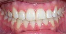 23 year old female treated with Braces