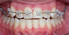 23 year old female treated with Braces