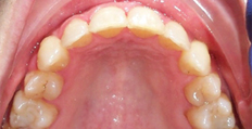 46 year old male treated with Braces, severe upper bicuspid rotation