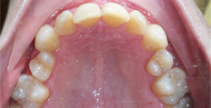 46 year old male treated with Braces, severe upper bicuspid rotation