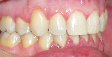 46 year old male treated with Braces, treated with rotated tooth