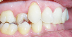 46 year old male treated with Braces, treated with rotated tooth