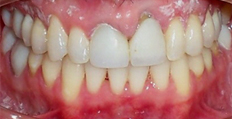 47 year old male treated with Braces