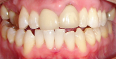 47 year old male treated with Braces