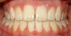 21 year old female treated with Braces