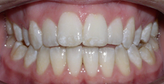 21 year old female treated with Braces