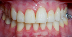 33 year old female treated with Braces