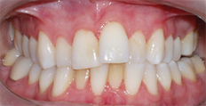 33 year old female treated with Braces