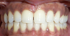 32 year old female treated with Invisalign