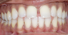 32 year old female treated with Invisalign