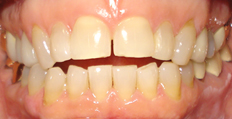 58 year old female treated with Invisalign