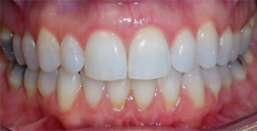 52 year old female treated with Invisalign