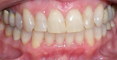 53 year old female treated with Invisalign