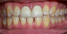 40 year old male treated with Invisalign