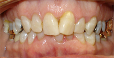 76 year old female treated with Invisalign 