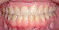 33 year old female treated with Invisalign