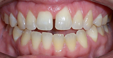 33 year old female treated with Invisalign