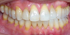 45 year old male treated with Invisalign