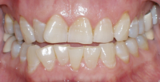 62 year old female treated with Invisalign