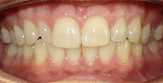 30 year old male treated with Invisalign