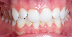 25 year old female treated with Invisalign