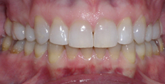 50 year old female treated with Invisalign Long term Stability