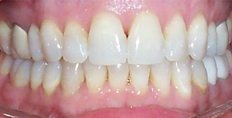 39 year old female treated with Invisalign