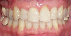 54 year old male treated with Invisalign