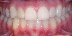 20 year old female treated with Invisalign