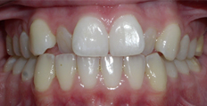 20 year old female treated with Invisalign