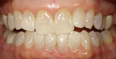 60 year old female treated with Invisalign