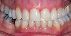 72 year old female treated with Invisalign 