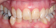 72 year old female treated with Invisalign 