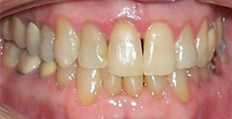 71 year old male treated with Invisalign