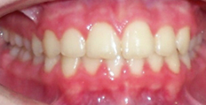 11 year old female treated with Braces 