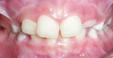 11 year old female treated with Braces 